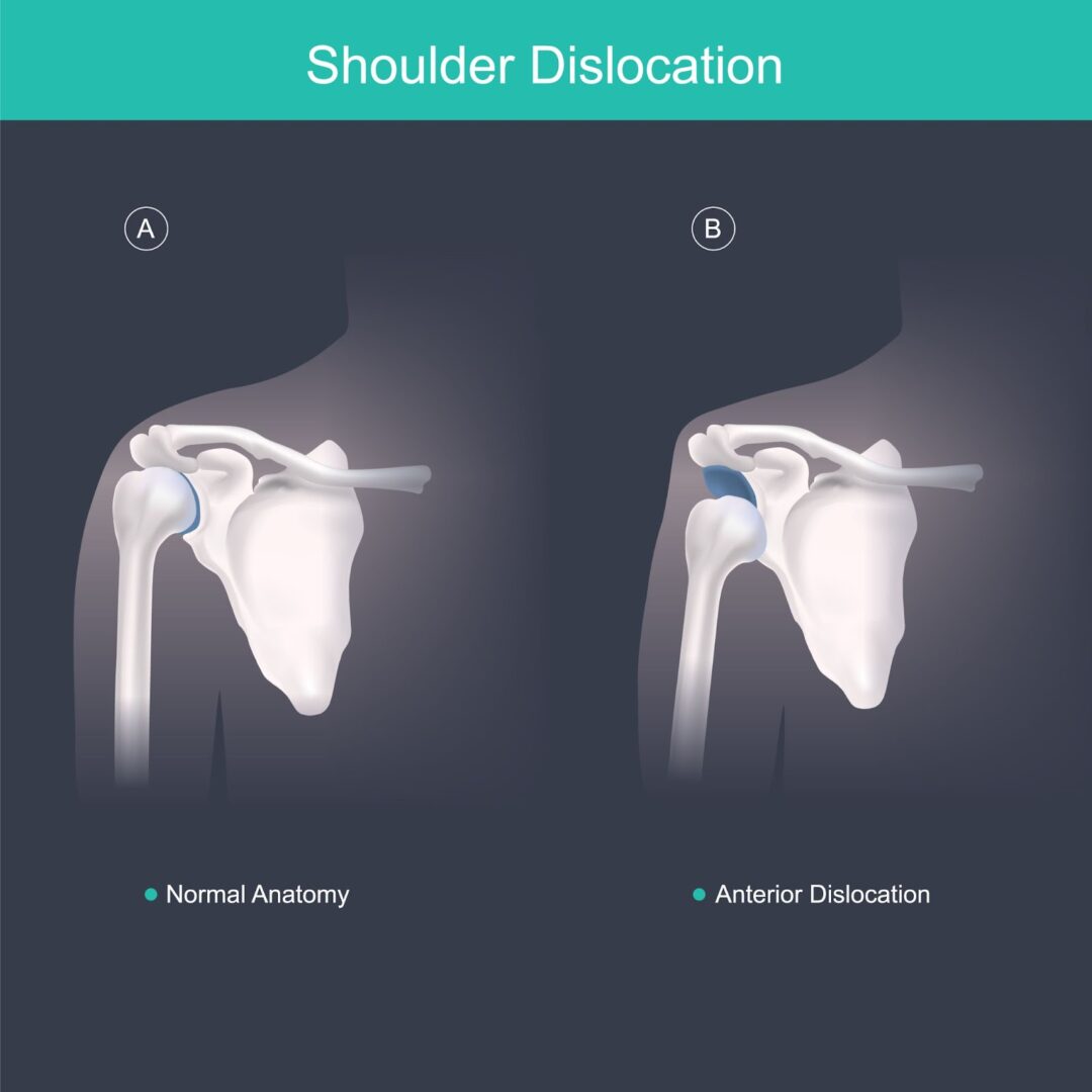 Humurus Dislocation Shouldering Your Dislocation Pain | Orthopaedic Associates of Duluth